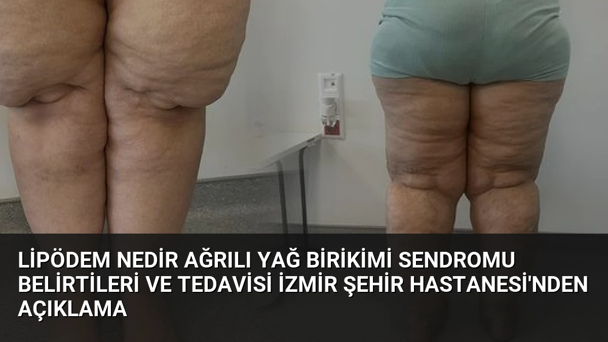 Lipödem Nedir Ağrılı Yağ Birikimi Sendromu Belirtileri ve Tedavisi İzmir Şehir Hastanesi’nden Açıklama